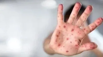 تقرير خطير.. تنشر منظمة الصحة العالمية تقريرها الـ54 عن تفشي مرض جدرى القرود في العديد من البلدان والذي يقدم تفاصيل صادمة عن الوضع الوبائي العالمي