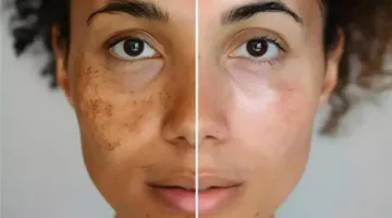 حصريًا أسباب اسمرار البشرة وكيف تؤثر بعض الأدوية والعلاجات على لون الجلد