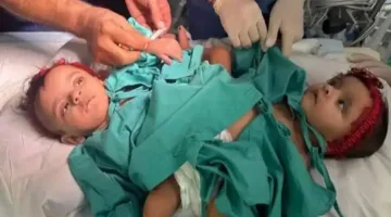 لحل مشكلة فصل التوأم يارا ولارا في الرياض بعملية ناجحة.. تعرف على تفاصيل المعجزة الطبية