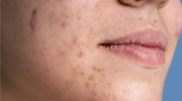 أفضل الحلول الطبيعية لإنهاء معاناة حب الشباب والحد من انتشار الرؤوس السوداء وجدولة آثارها